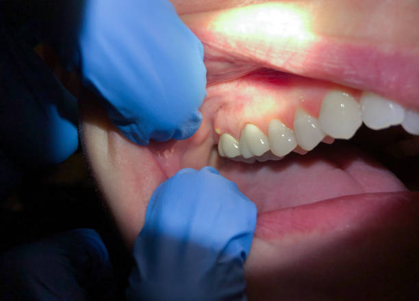 Best Emergency Root Canal Treatment in Newport, SC