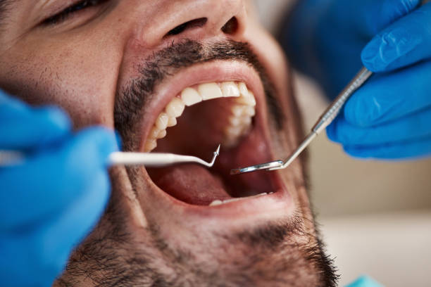 Best Emergency Dental Extractions in Newport, SC